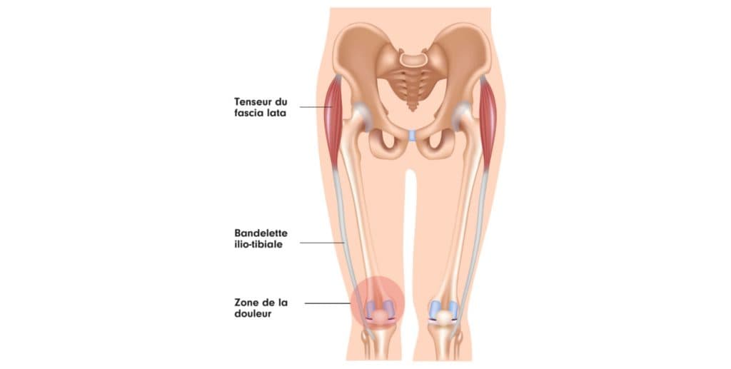 image expliquant le syndrome de l'essuie glace