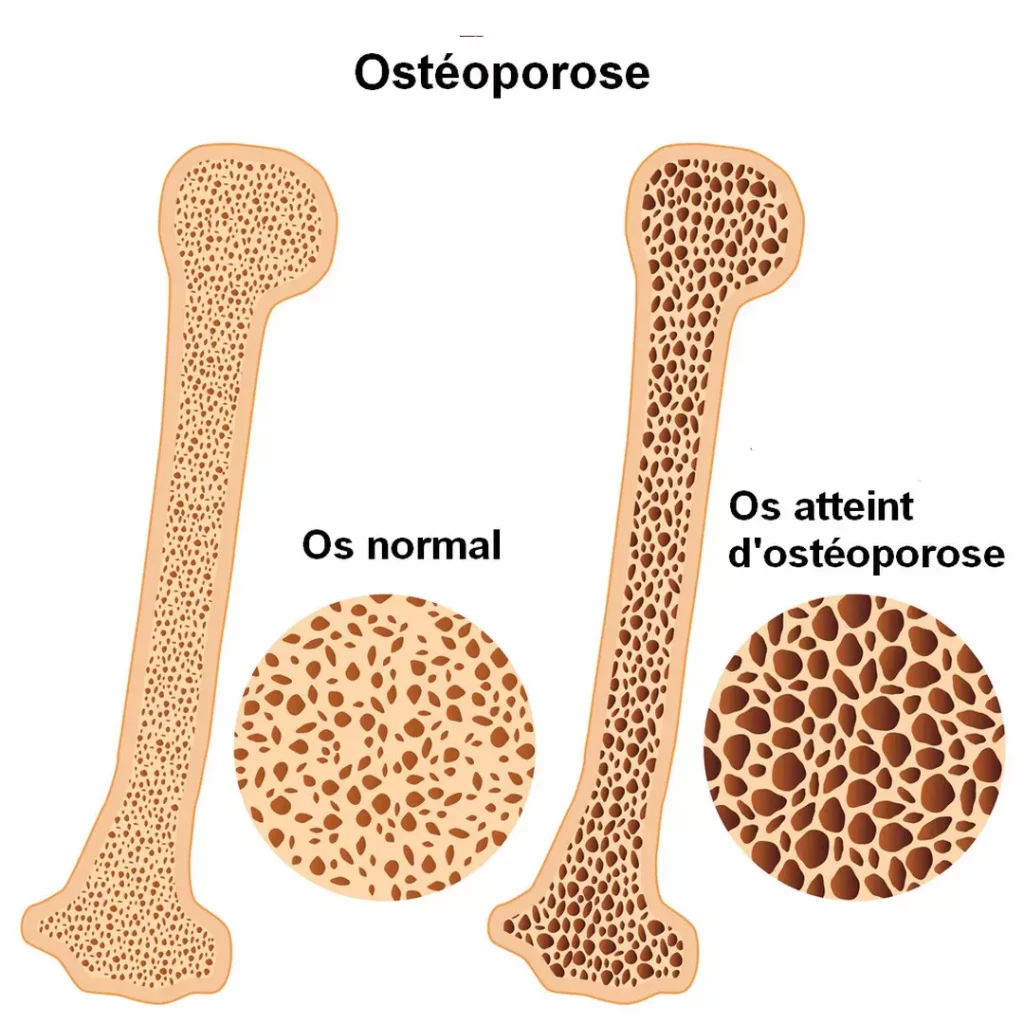 image de l'Ostéoporose