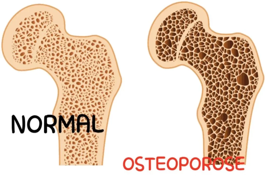 difference entre os normal et os Ostéoporose